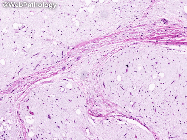 Soft Tissue_Lipomatous_Lipoblastoma16_resized.jpg